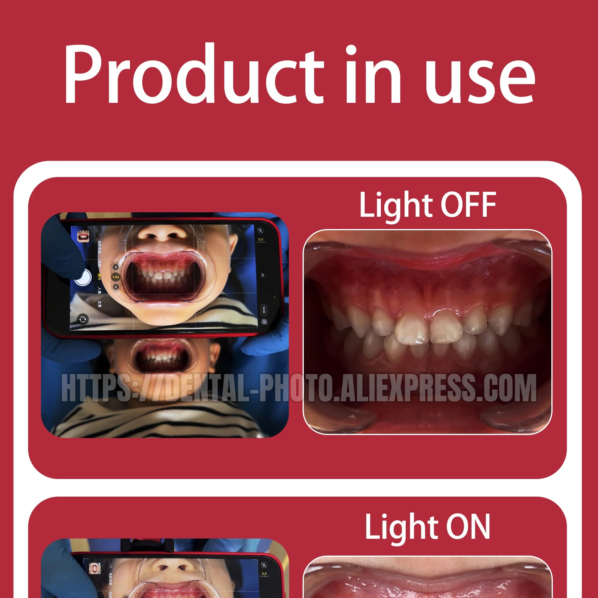 Dental Photo - MK 16 | Dental Photography Light For Cellphone. LED For Dentistry. Polarized And Macro Photos For Dentist