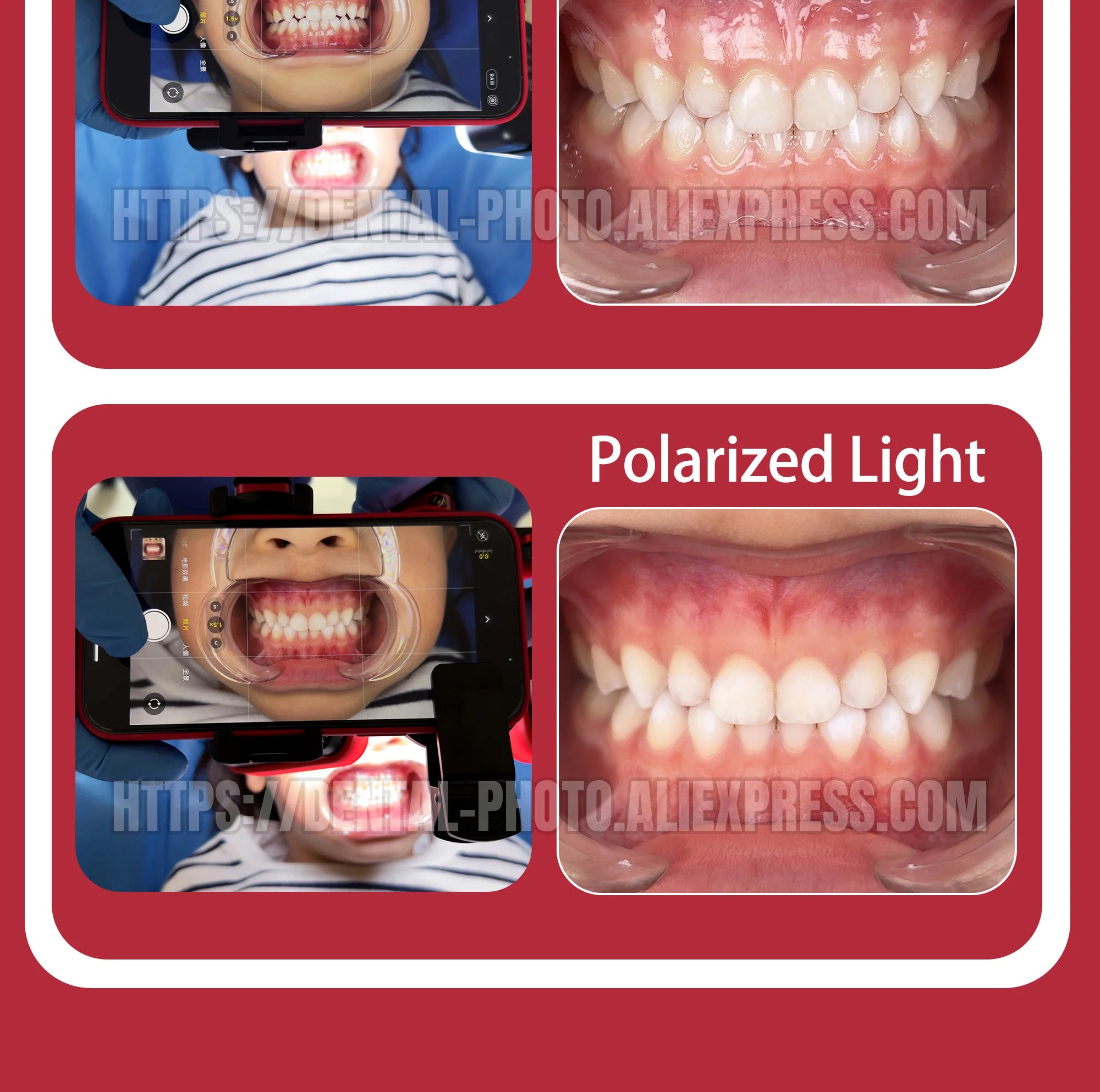 Dental Photo - MK 16 | Dental Photography Light For Cellphone. LED For Dentistry. Polarized And Macro Photos For Dentist