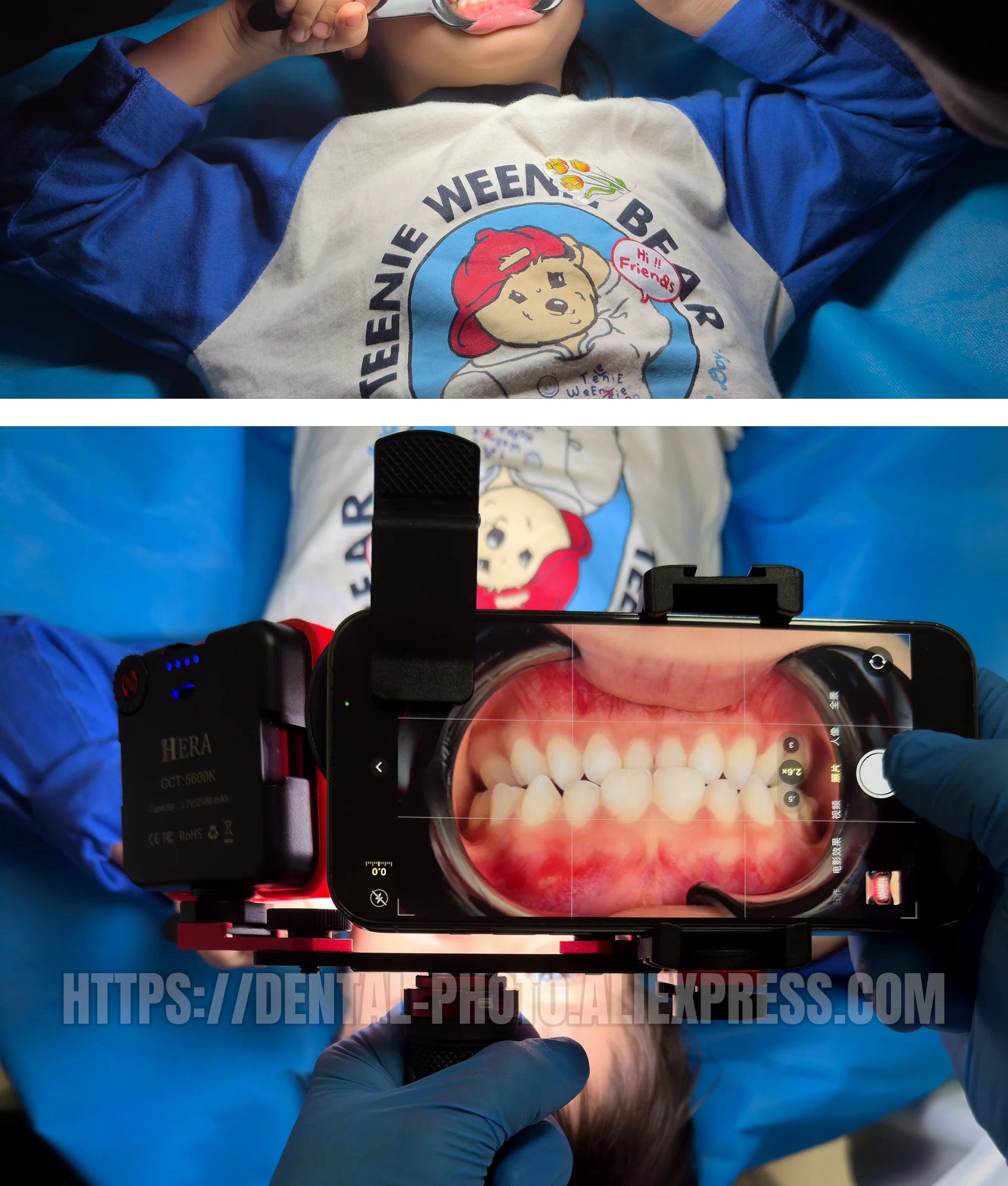 Dental Photo - MK 16 | Dental Photography Light For Cellphone. LED For Dentistry. Polarized And Macro Photos For Dentist