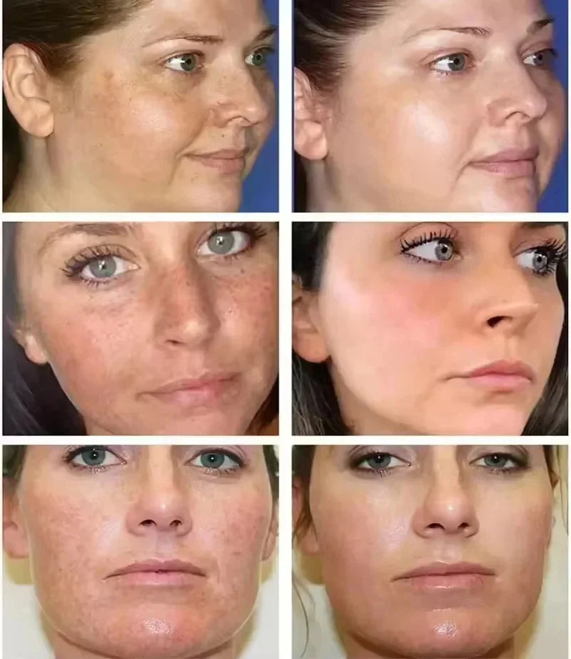 Retinol Whitening Freckle Cream Melasma Dark Spots Pigmentation Removal Fade Stain Melanin Fast Repair Brighten Korean Skin Care