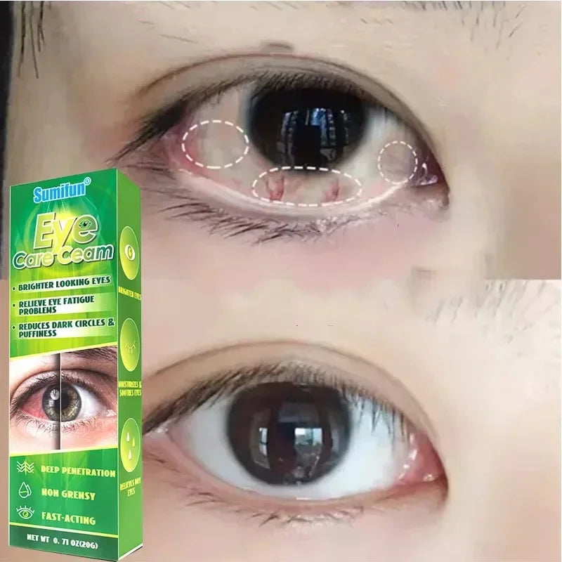 Sumifun 20g Chinese Herbal Medicine Eye Care Cream Brighter Looking Eyes Relieve Eye Fatigue Problems Eyes Red Blood Clear
