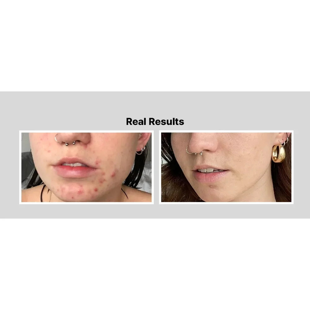 Cosrx BHA Blackhead Power Removal Snail Essence BHA Salicylic Acid Cleaning Pores Moisturizing 100ML Dark Spot Remover For Face