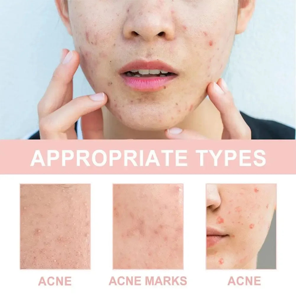 1box /72 Patch Acne Pimple Patch Stickers Acne Treatment Pimple Remover Tool Blemish Spot Facial Mask Skin Care Waterproof