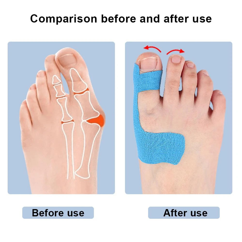 10 PCS Precut Bunion Corrector Tape - Big Toe Pain  for Hallux Valgus,Breathable Hypoallergenic Kinesiology Tape for Men & Women