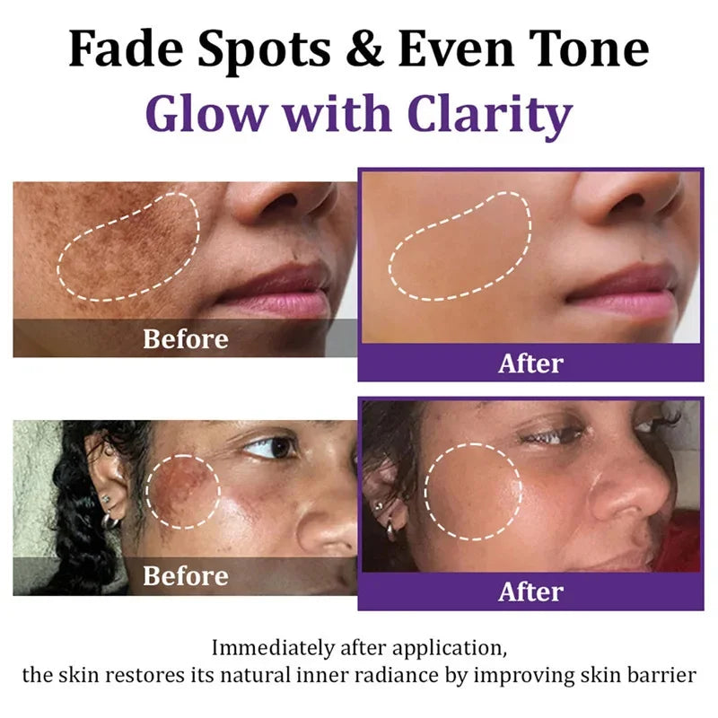 Retinol Whitening Freckle Cream Melasma Dark Spots Pigmentation Removal Fade Stain Melanin Fast Repair Brighten Korean Skin Care