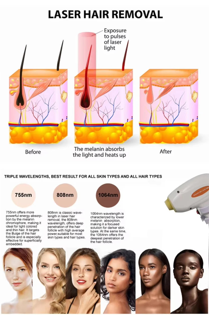 808 Diode Laser Hair Removal Machine: 2025 4-Wave, Painless, Permanent, Portable 4000W Device -  Soprano Titanium.