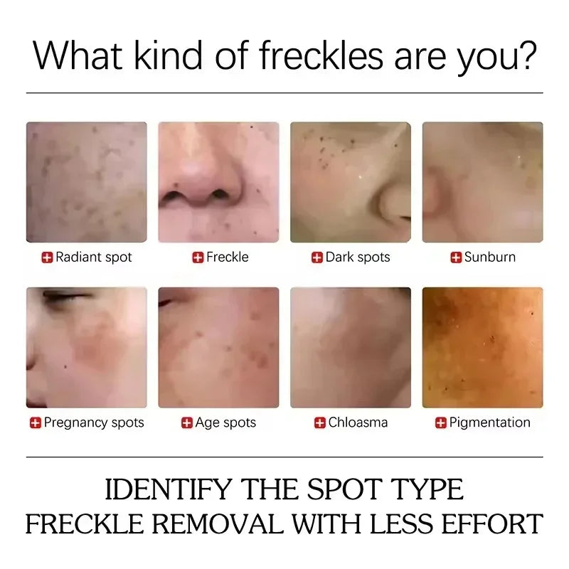 Retinol Whitening Freckle Cream Melasma Dark Spots Pigmentation Removal Fade Stain Melanin Fast Repair Brighten Korean Skin Care