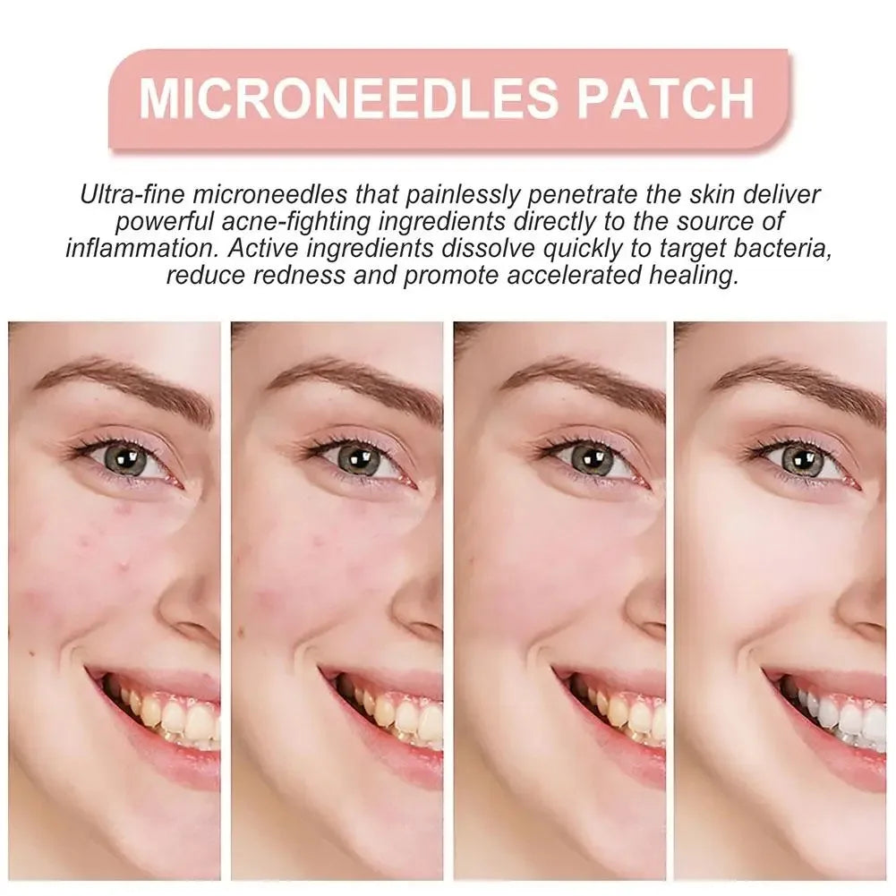 1box /72 Patch Acne Pimple Patch Stickers Acne Treatment Pimple Remover Tool Blemish Spot Facial Mask Skin Care Waterproof