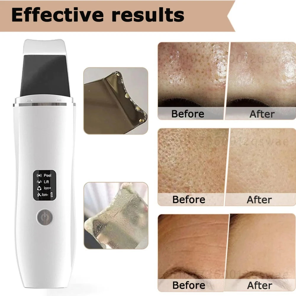 Ultrasonic Skin Scrubber Facial Deep Cleansing Blackhead Remove Ultrasonic Cleansing Cavitation Peeling Shovel Skin Scrubber